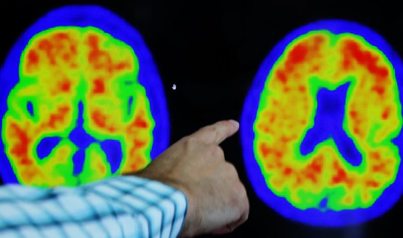 &copy; Reuters. FOTO DE ARCHIVO. El Dr. Seth Gale señala indicios de enfermedad de Alzheimer en tomografías PET en el Centro de Investigación y Tratamiento del Alzheimer (CART) del Hospital Brigham And Women's de Boston, Massachusetts, EEUU. 30 de marzo de 2023. REUTE