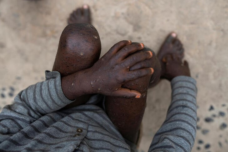 &copy; Reuters. Imagen de un niño de tres años afectado por el virus del mono en su casa en Yalokombe, República Democrática del Congo. 4 octubre 2022. REUTERS/Arlette Bashizi
