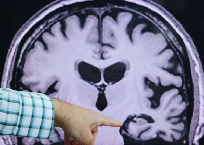 © Reuters. Dr. Seth Gale points out evidence of Alzheimer’s disease on an MRI at the Center for Alzheimer Research and Treatment (CART) at Brigham And Women’s Hospital in Boston, Massachusetts, U.S., March 30, 2023. REUTERS/Brian Snyder/FILE PHOTO