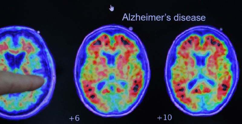 © Reuters. FILE PHOTO: Dr. Seth Gale points out evidence of Alzheimer’s disease on PET scans at the Center for Alzheimer Research and Treatment (CART) at Brigham And Women’s Hospital in Boston, Massachusetts, U.S., March 30, 2023. REUTERS/Brian Snyder/File Photo