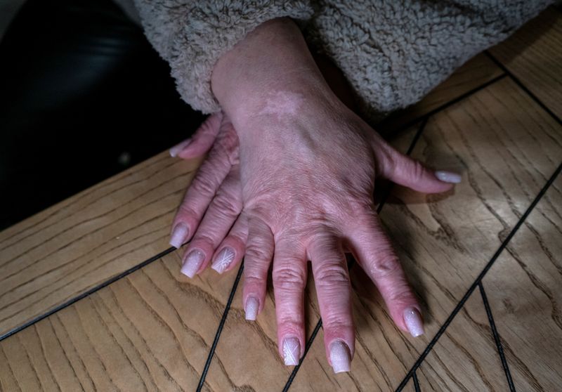 &copy; Reuters. امرأة تبلغ من العمر 44 عاما تعرض كيف تعرضت للتعذيب على أيدي القوات الروسية خلال حديثها مع رويترز في خيرسون يوم 11 ديسمبر كانون الأول 2022. تصوير: 