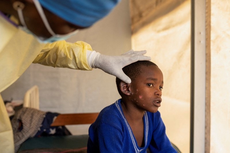 &copy; Reuters. FILE PHOTO: Dr. Tresor Wakilongo, verifies the evolution of skin lesions on the ear of Innocent, suffering from Mpox - an infectious disease caused by the monkeypox virus that sparks off a painful rash, enlarged lymph nodes and fever; at the treatment cen