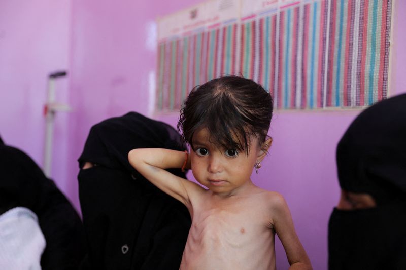 &copy; Reuters. FILE PHOTO: A malnourished girl waits at a measurement room of a hospital as Yemeni children face the risk of medical complications amid high levels of food insecurity, in Sanaa, Yemen March 2, 2024. REUTERS/Khaled Abdullah/File Photo