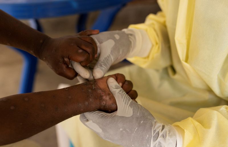 &copy; Reuters. Enfermeira coleta amostra de criança com suspeita de infecção por mpox no território de Nyiragongo, perto de Goma, na província de Kivu do Norte, na República Democrática do Congon19/07/2024 REUTERS/Arlette Bashizi