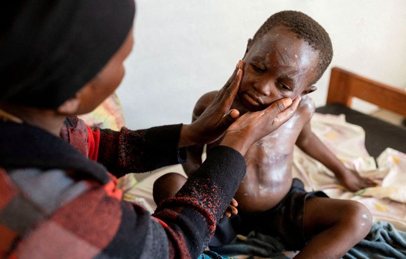 &copy; Reuters. Furaha Elisabeth aplica medicamentos na pele de seu filho Sagesse Hakizimana, em tratamento contra mpox  em um centro de saúde em Munigi, território de Nyiragongo, na República Democrática do Congon19/08/2024nREUTERS/Arlette Bashizi