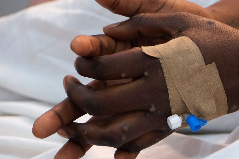 © Reuters. FILE PHOTO: The hands of a patient with skin rashes caused by the mpox virus are pictured in Kinshasa, Democratic Republic of Congo August 30, 2024. REUTERS/Justin Makangara/File Photo