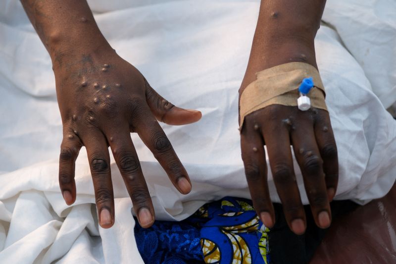 © Reuters. The hands of a patient with skin rashes caused by the mpox virus are pictured at the treatment center of Vijana Hospital in Kinshasa, Democratic Republic of Congo August 30, 2024. REUTERS/Justin Makangara/File Photo