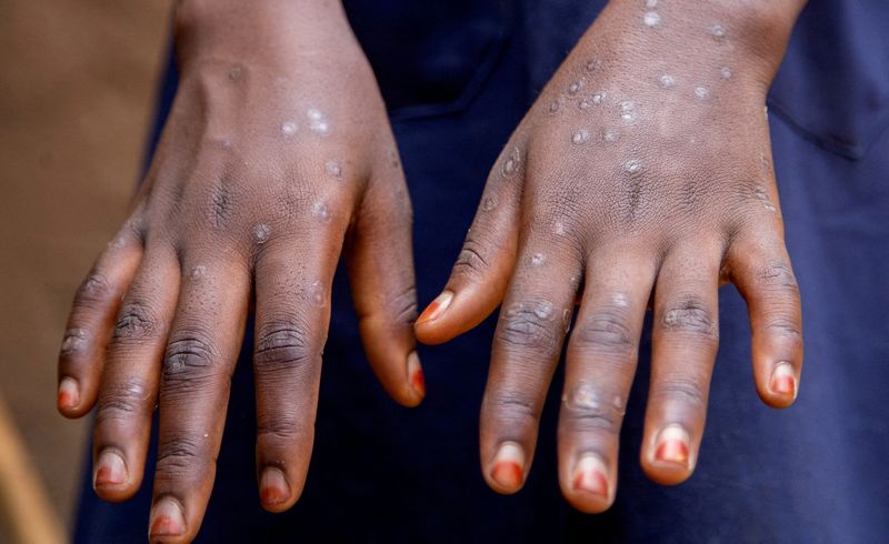 &copy; Reuters. Sumaya Hatungimana, de 12 anos, do Burundi, mostra marcas nas mãos após se recuperar de mpoxn28/08/2024nREUTERS/Ngendakumana Evrard