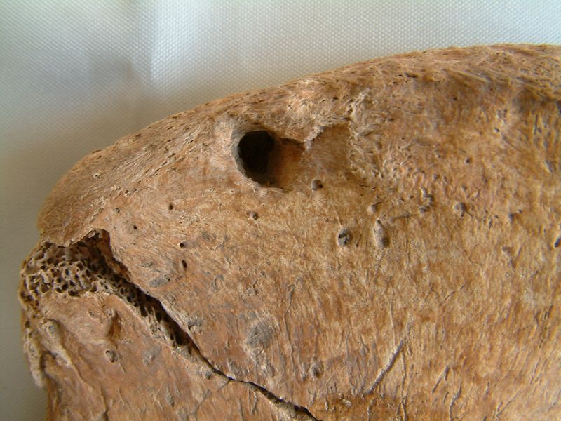 &copy; Reuters. Ferimento de perfuração causado pela mordida de um grande felino na pélvis de um homem que acredita-se ter sido um gladiador nos tempos da Roma Antiga, foi enterrado em um cemitério perto de York, Reino Unidon23/04/2025nThompson et al., 2025, PLOS One
