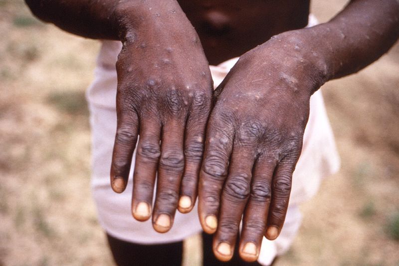 &copy; Reuters. 　５月１９日、米マサチューセッツ州公衆衛生局は、１人の男性のサル痘感染を確認したと発表した。写真は発疹の出た患者の手。提供写真（２０２２年　ロイター／CDC）
