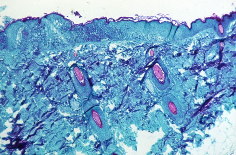 &copy; Reuters. A section of skin tissue, harvested from a lesion on the skin of a monkey, that had been infected with monkeypox virus, is seen at 50X magnification on day four of rash development in 1968. CDC/Handout via REUTERS